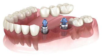 A Guide to Dental Implants for Seniors in the U.S.: Costs, Age Comparison & Money-Saving Tips