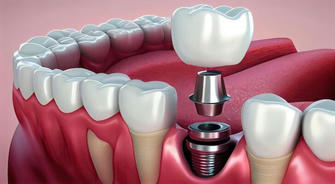 Unlock Massive Savings on Dental Implants: The Ultimate Guide for Seniors in 2025!